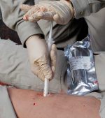 XSTAT 12® Injectable Hemostatic Device by RevMedX in use on mannequin | Panakeia Medical Products Distributor